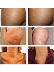 Cellulite Treatment Carboxytherapy - Dermacare Aesthetic & Laser Institute