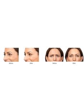Anti wrinkle Injections  - Dermacare Aesthetic & Laser Institute