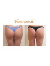 Cellulite Treatment VelaShape® - Dermacare Aesthetic & Laser Institute