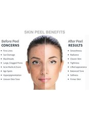 Chemical Peel Nimue Lamelle and Hannon - Dermacare Aesthetic & Laser Institute