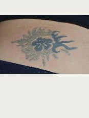 Ever Essence - Tattoo Removal