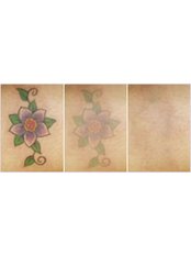 Laser Tattoo Removal - Emerald Rain Tattoos