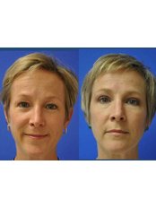 Non-Surgical Eye Lift - The Aesthetics HQ
