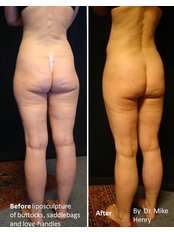 Butt Implants - Taryn Laine Clinic