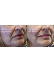 Non-Surgical Facelift - Taryn Laine Clinic