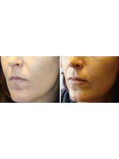 Lip Augmentation - Taryn Laine Clinic