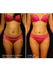 Liposuction - Taryn Laine Clinic