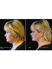 Neck Liposuction - Taryn Laine Clinic