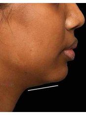 Jawline Slimming - Lightsculpt Aesthetic Clinic