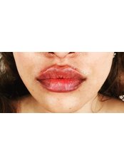 Lip Augmentation - Lightsculpt Aesthetic Clinic