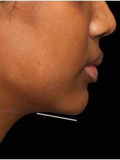 Jawline Slimming - Lightsculpt Aesthetic Clinic