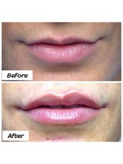 Lip Augmentation - The Rejuvenation Clinic