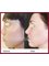 Dra. Virginia Benitez Roig - Marbella - Bioplasty Face and Body Non-Surgical Lifting  