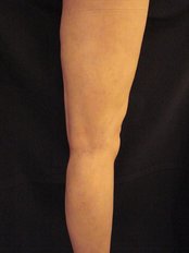 Sclerotherapy - Marbella Vein and Beauty Clinic