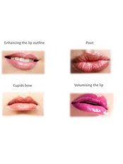 Lip Augmentation - REJUVENATE - Facial Aesthetics