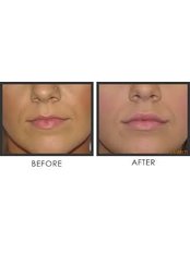 Lip Augmentation - REJUVENATE - Facial Aesthetics