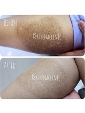 IPL Skin Rejuvenation - Athena Clinic
