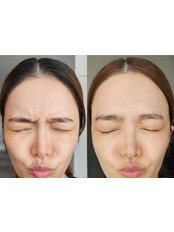 Treatment for Wrinkles - Dr. Tony Beauty Expert