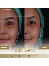 Thermage® - Dr. Tony Beauty Expert