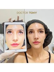 Dermal Fillers - Dr. Tony Beauty Expert
