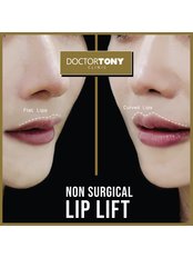 Lip Filler - Dr. Tony Beauty Expert