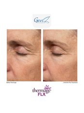 Thermage® FLX (Newest version) - GenZ Clinic - The Glory