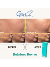 Skin Booster - GenZ Clinic - The Glory