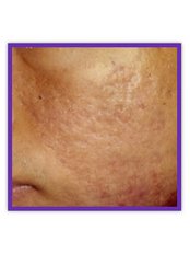 Acne Scars Treatment - La Cherie Cosmetic Laser Centre