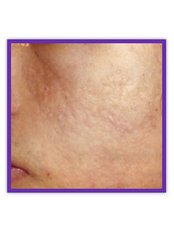 Acne Scars Treatment - La Cherie Cosmetic Laser Centre