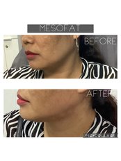 Fat Reduction Injections - MesoFat - MedConsult Clinic