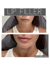 Lip Filler - MedConsult Clinic
