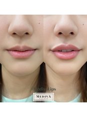 Lip Filler - Mediva Clinic