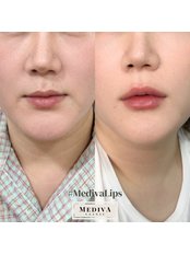 Lip Filler - Mediva Clinic