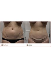 Bodytite  Radio Frequency Assisted Liposuction - The Med Clinic Siam