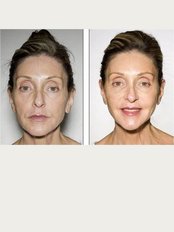 The Med Clinic Siam - Ulthera treatment before and after photo