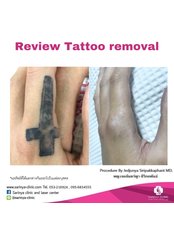 Laser Tattoo Removal - Sarinya Clinic- Chiang Mai Thailand