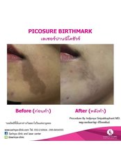 Birthmark Removal - Sarinya Clinic- Chiang Mai Thailand