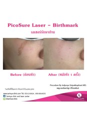 Birthmark Removal - Sarinya Clinic- Chiang Mai Thailand