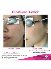 Whitening Laser / Laser Rejuvenation - Sarinya Clinic- Chiang Mai Thailand