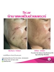 Scar treatment - Sarinya Clinic- Chiang Mai Thailand