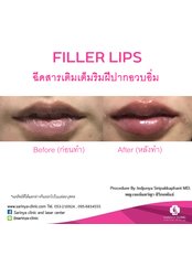 Dermal Fillers - Sarinya Clinic- Chiang Mai Thailand