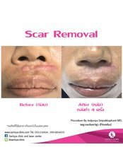 Scar Removal - Sarinya Clinic- Chiang Mai Thailand