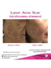 Laser Acne (Full Face) - Sarinya Clinic- Chiang Mai Thailand