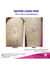 Cool Glide Laser ,vein - Sarinya Clinic- Chiang Mai Thailand