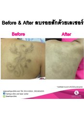 Laser Tattoo Removal - Sarinya Clinic- Chiang Mai Thailand