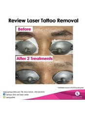 Medlite C6 Laser -Tattoo Removal - Sarinya Clinic- Chiang Mai Thailand
