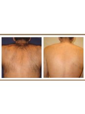 Laser Hair Removal - Aesthe Clinic