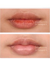 Lip Filler - Aesthe Clinic