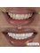 My Imperial Care - Smile Makeover with Zirconia Crowns 