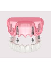 All-on-4 Dental Implants - Estheroyal